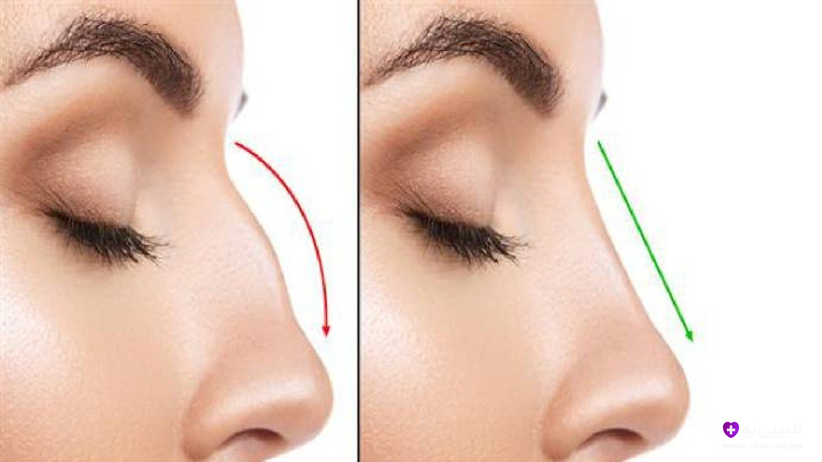 مقایسه نوک بینی افتاده قبل (چپ) و نوک بینی سربالا پس از رینوپلاستی (راست)