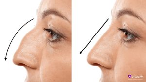 اصلاح افتادگی نوک بینی در عمل بینی استخوانی