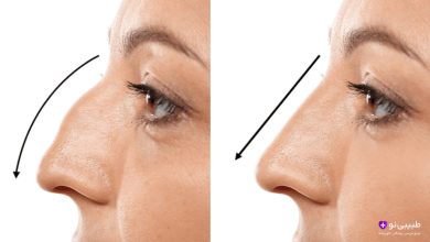 اصلاح افتادگی نوک بینی در عمل بینی استخوانی