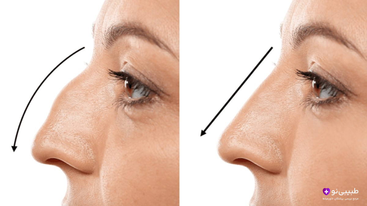 اصلاح افتادگی نوک بینی در عمل بینی استخوانی