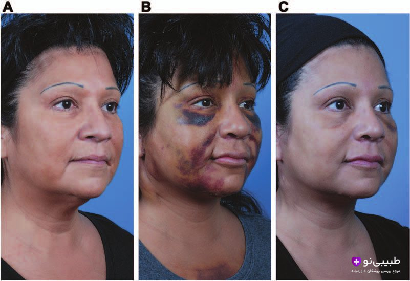 مای سه‌مرحله‌ای عوارض کبودی پس از لیفت صورت در یک بیمار؛ قبل از عمل - روزهای سوم تا پنجم - هفته دوم تا سوم