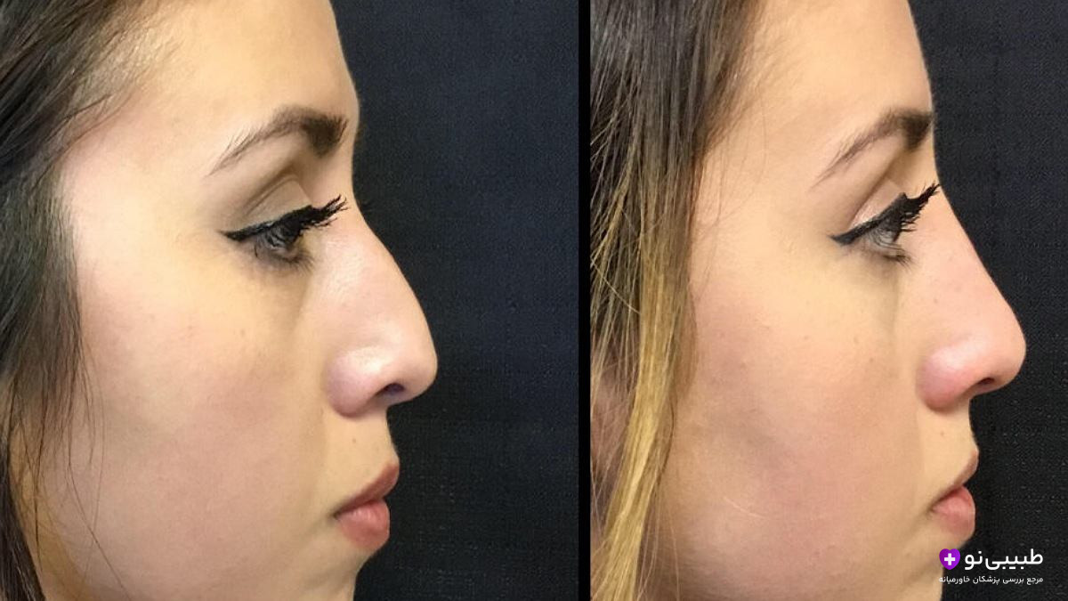 قبل و بعد تزریق چربی به بینی – اصلاح قوز و لیفت نوک بینی با چربی خود فرد