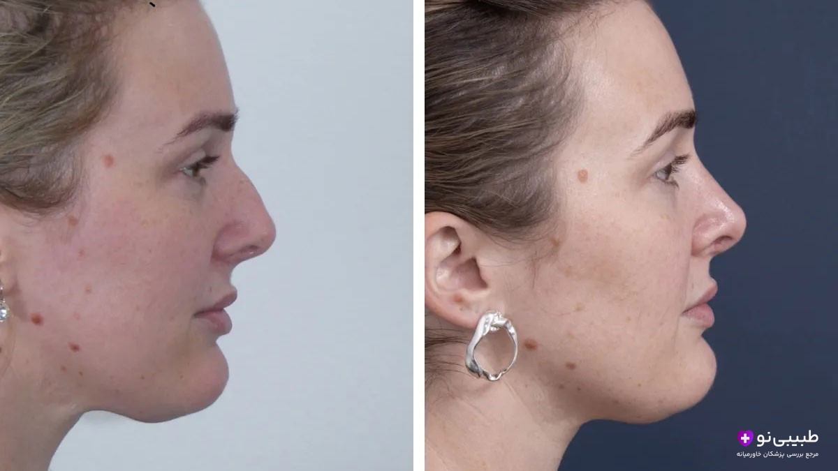 نمای نیم‌رخ زن جوان با بینی بزرگ و نوک افتاده در سمت چپ و بینی ظریف و سربالا پس از رینوپلاستی در سمت راست