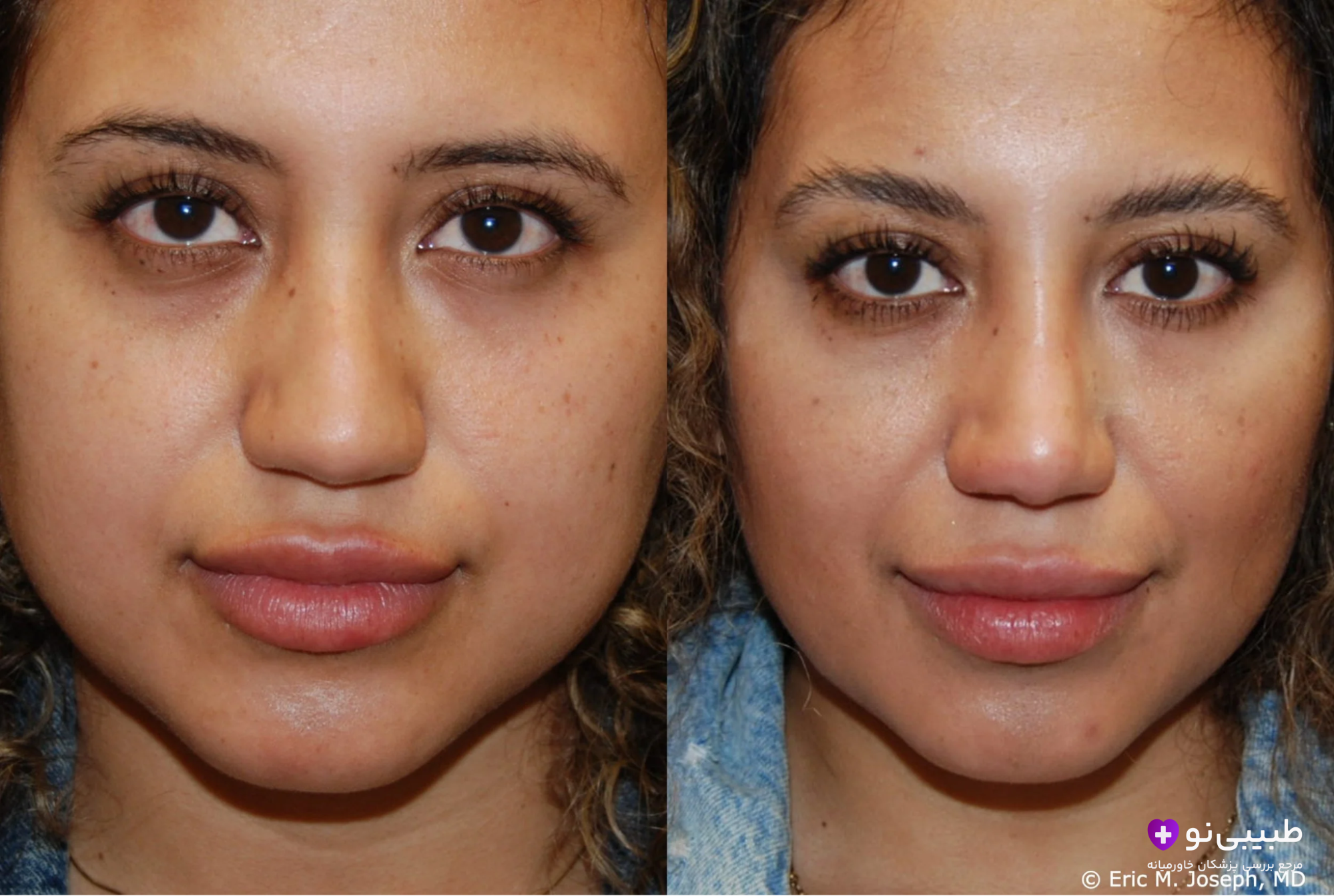 تصویر قبل و بعد جراحی بینی گوشتی: سمت چپ بینی پهن و نوک گرد، سمت راست بینی باریکتر، نوک ظریف و خطوط طبیعیتر با پوست صاف و تناسب چهره.