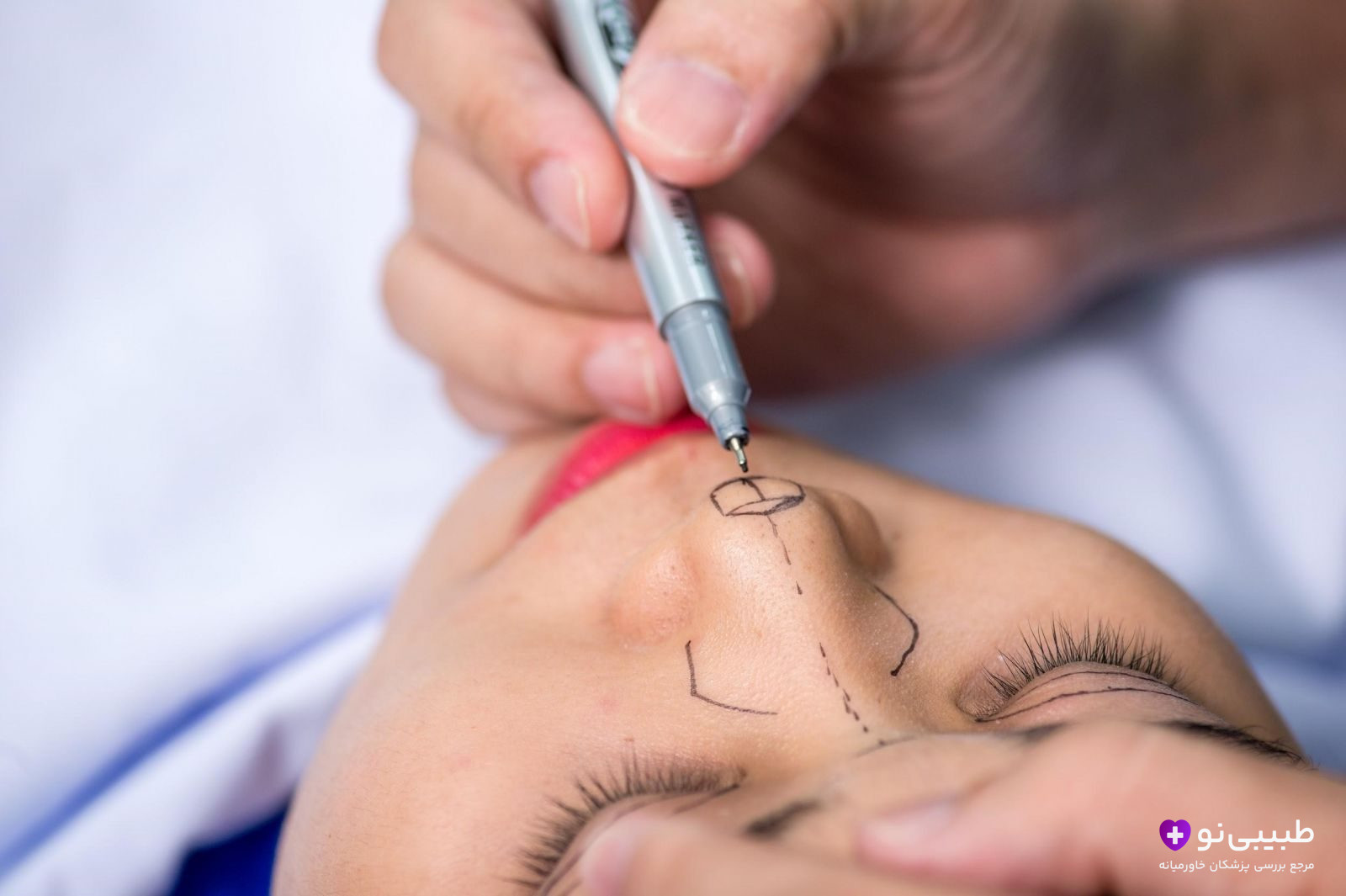 جراح در حال علامتگذاری دقیق روی بینی گوشتی بیمار با ماژیک برای برنامهریزی جراحی رینوپلاستی، نشاندهنده دقت در طراحی نوک و پل بینی.