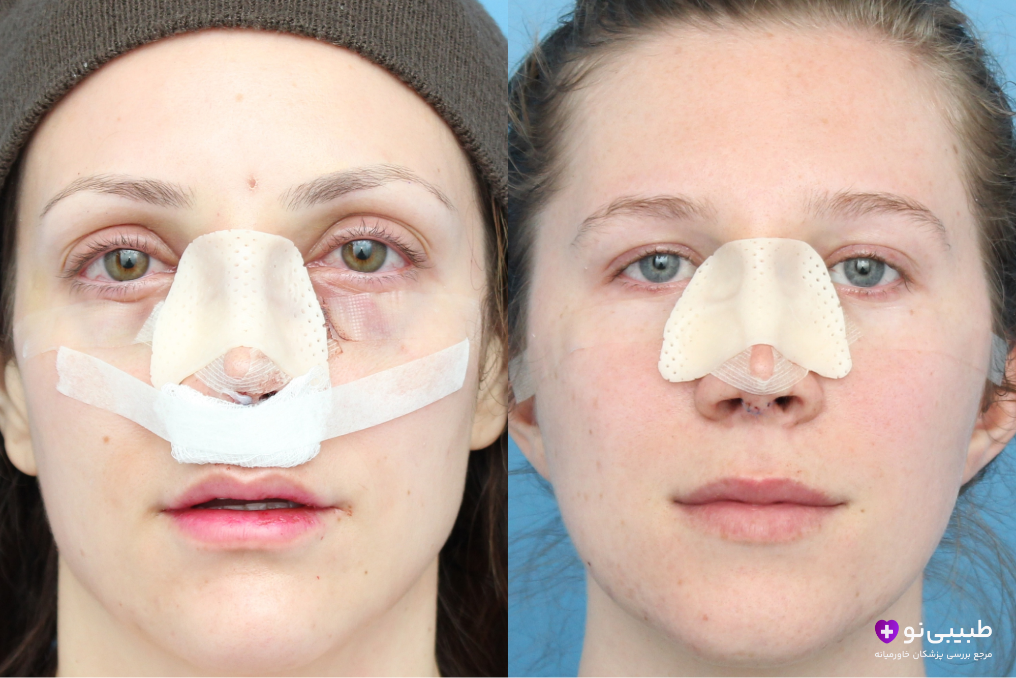 تصویر قبل و بعد اولیه جراحی بینی گوشتی: سمت چپ بلافاصله پس از عمل با اسپلینت و پانسمان کامل، سمت راست چند روز بعد با اسپلینت سبکتر و کاهش تورم اولیه.