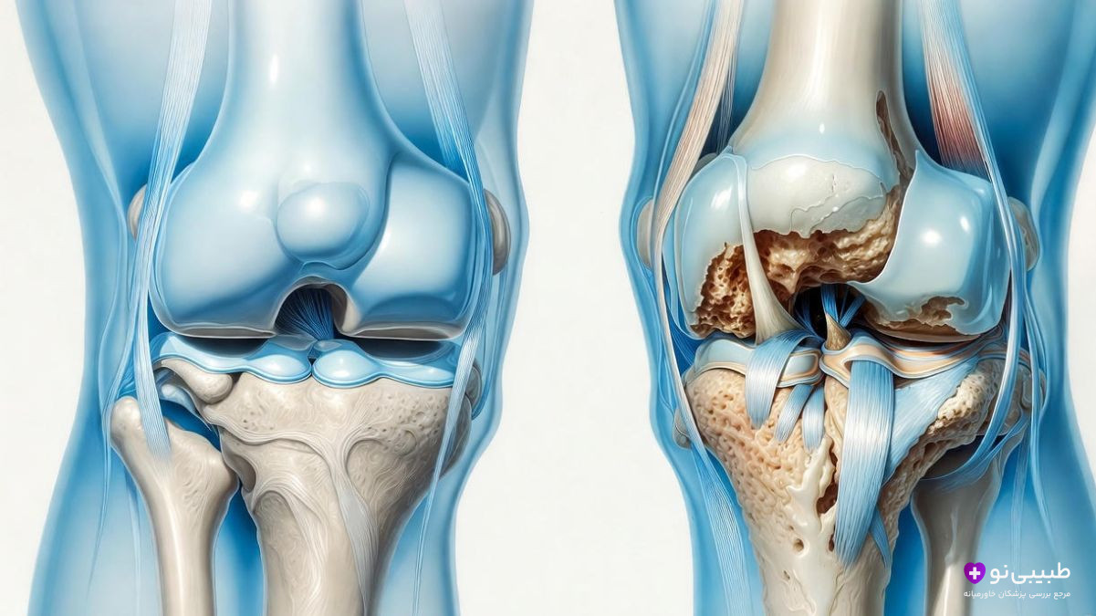 مقایسه مفصل زانوی سالم با زانوی آرتروزی دارای ساییدگی غضروف - نمای آموزشی دقیق با پس‌زمینه سفید و رنگ آبی پزشکی