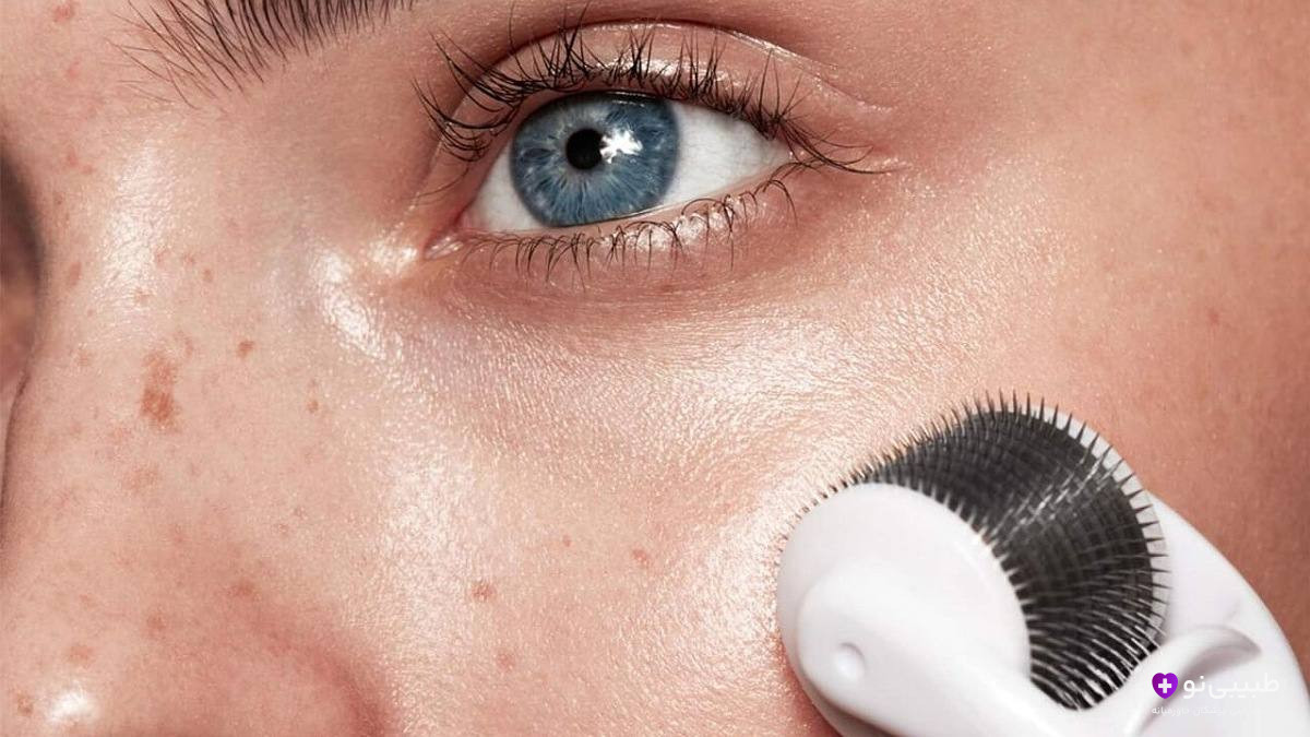 میکرونیدلینگ خانگی با درمارولر برای بهبود بافت پوست