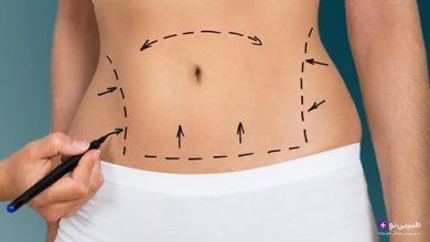 شکم زن با خطوط مشکی و فلش برای مشخص کردن نواحی لیپوساکشن