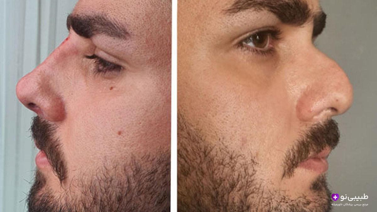 قبل و بعد تزریق فیلر بینی در آقای جوان برای اصلاح قوز و انحراف