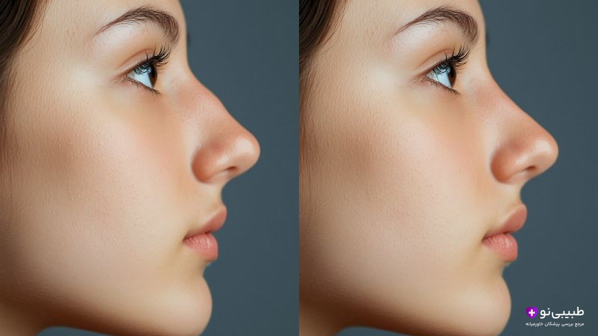 تغییرات بعد از عمل بینی