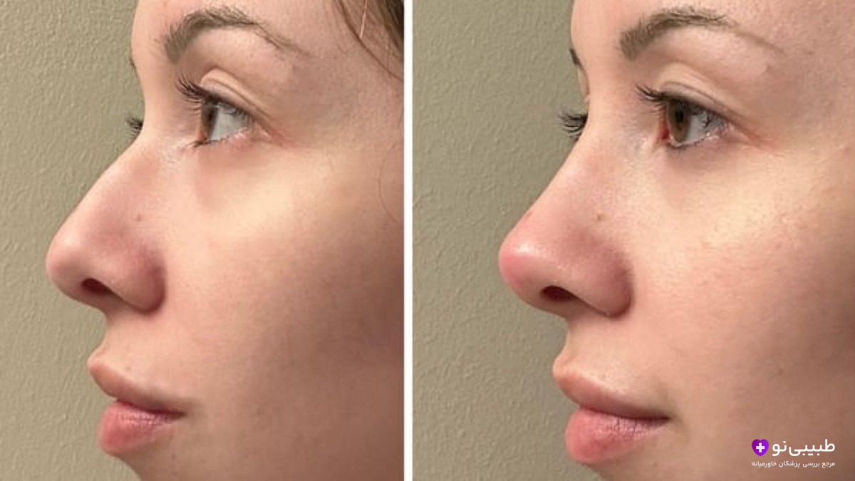 قبل و بعد تزریق فیلر بینی – لیفت ملایم نوک بینی و اصلاح قوز جزئی در خانم جوان