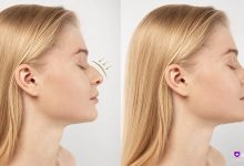 خانوم در تصویر قبل و بعد از عمل بینی