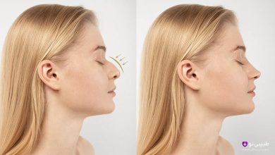 خانوم در تصویر قبل و بعد از عمل بینی