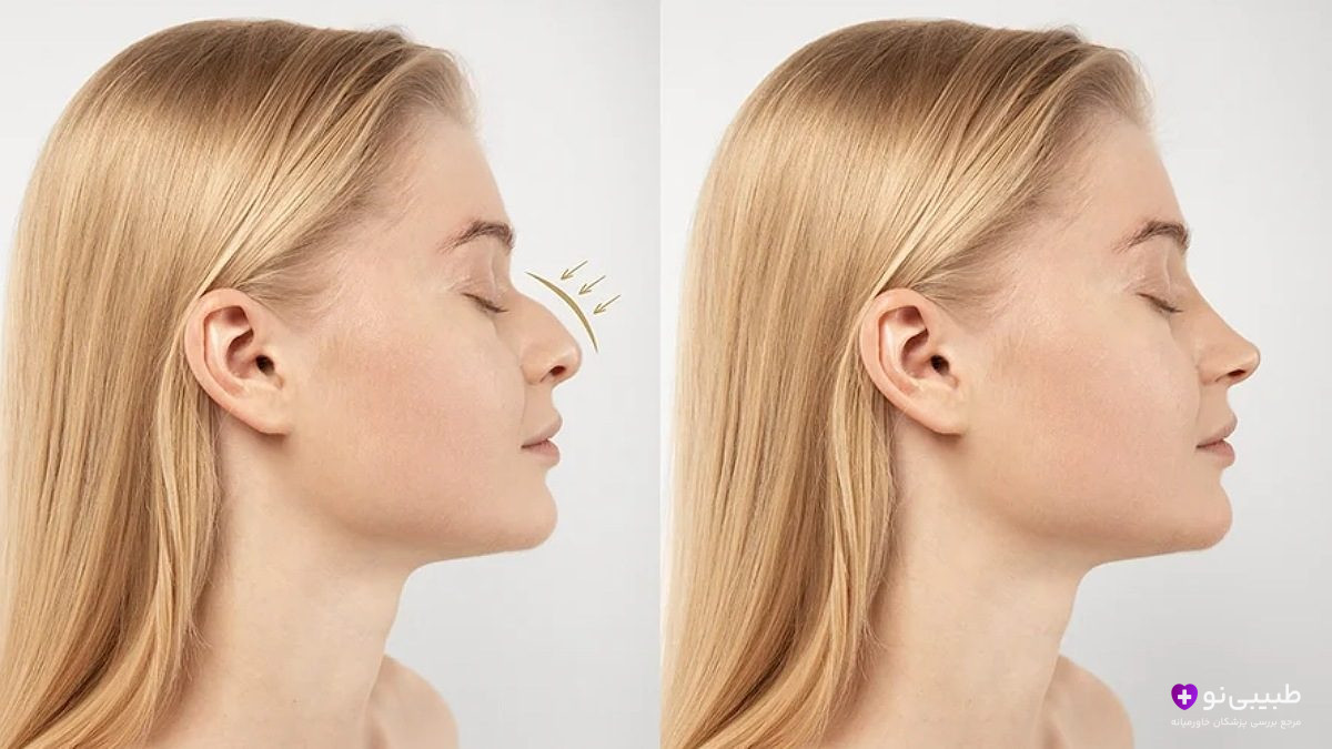 خانوم در تصویر قبل و بعد از عمل بینی