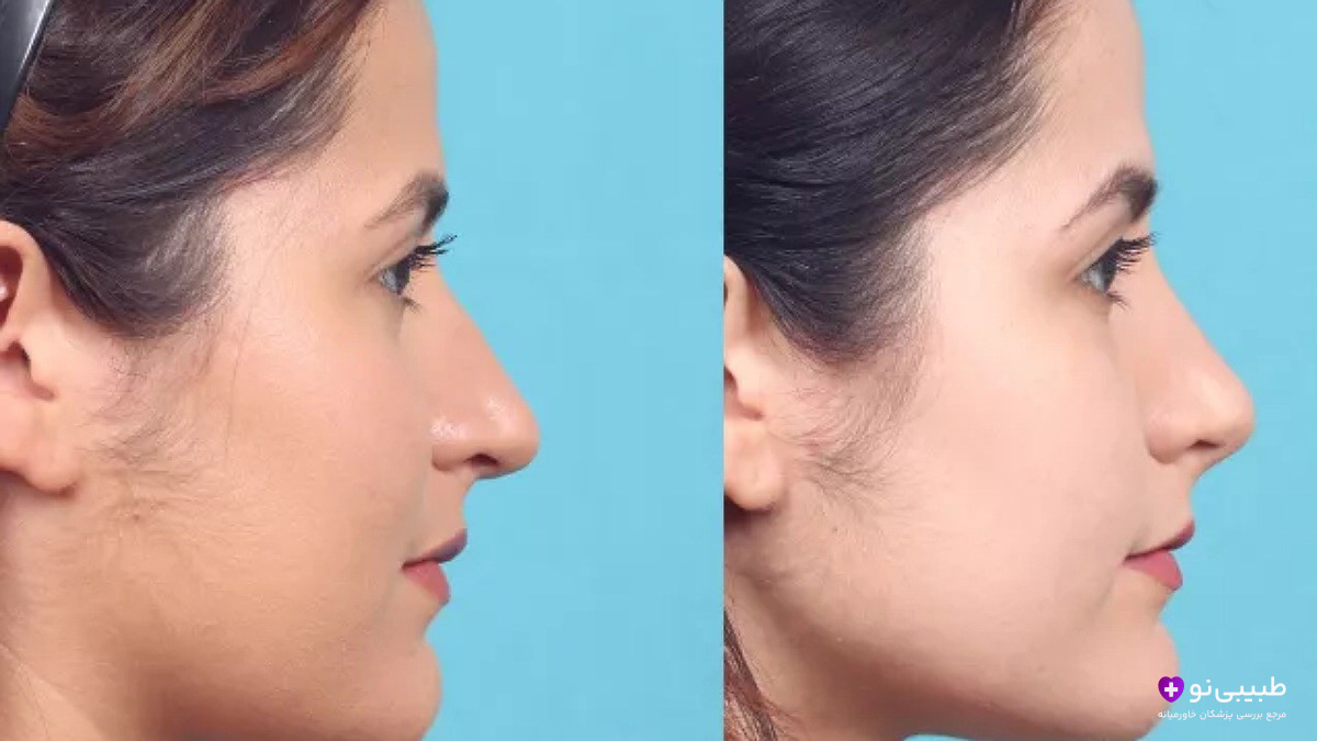 قبل و بعد لیفت بینی با نخ در خانم جوان – بالا بردن نوک بینی و صاف‌کردن پل بینی