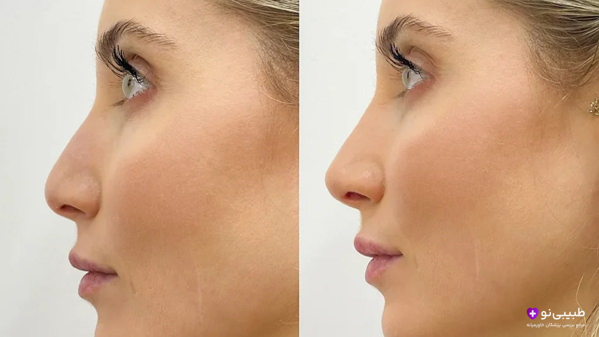 قبل و بعد لیفت بینی با پلاسماجت – بالا بردن نوک بینی و اصلاح افتادگی بدون تزریق و جراحی