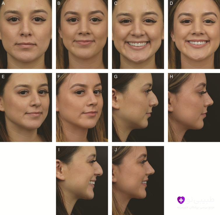 نمای چندزاویهای قبل و بعد رینوپلاستی پرزرویشن: تغییرات ظریف، طبیعی و هماهنگ با حفظ کامل ساختار بینی و بهبود تنفس، بدون ظاهر جراحیشده.