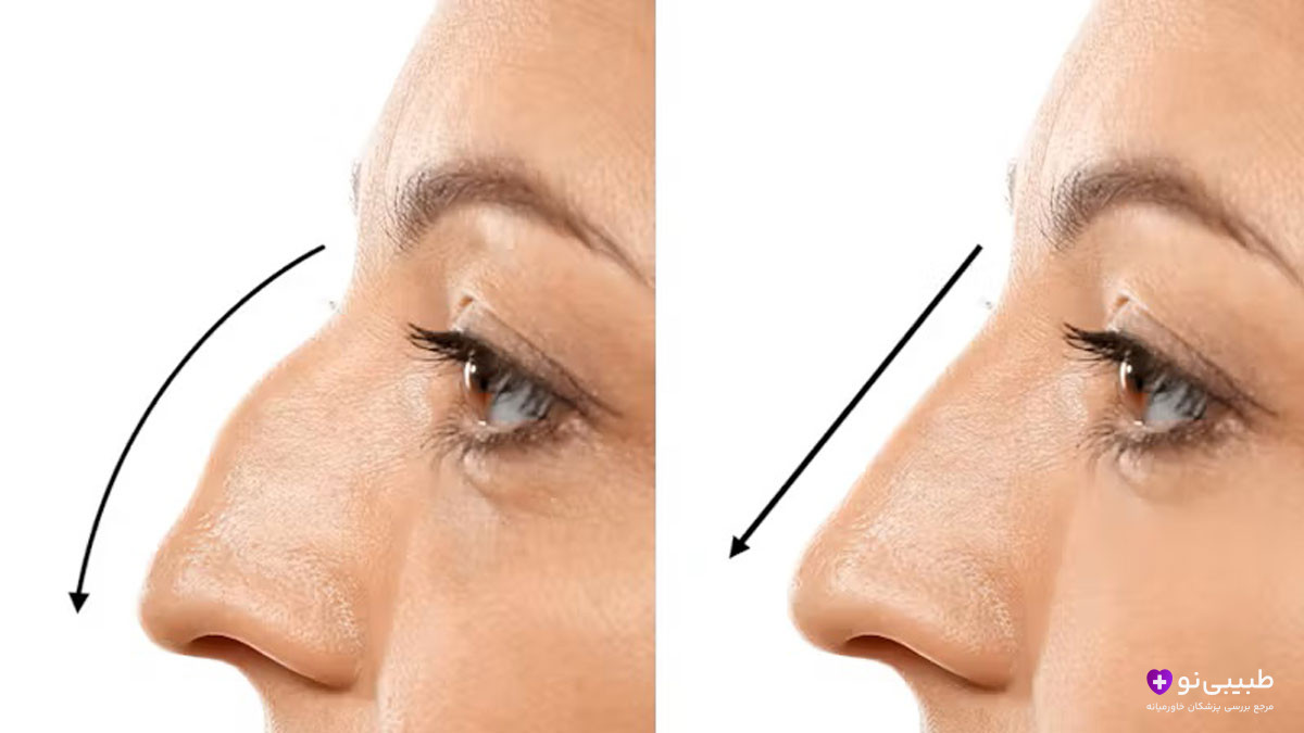 نمای نیم‌رخ زن از بینی قوزدار در سمت چپ و بینی صاف و بدون قوز در سمت راست با فلش مشکی