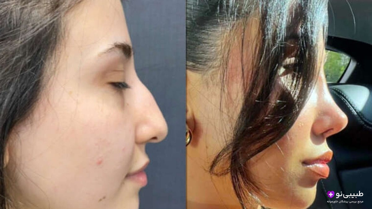 تصویر قبل و بعد عمل بینی؛ سمت چپ: نیمرخ بینی طبیعی با پوست معمولی و پسزمینه ساده، سمت راست: بینی کوچکتر و سربالا در داخل خودرو با موهای پوشاننده صورت و نور طبیعی.