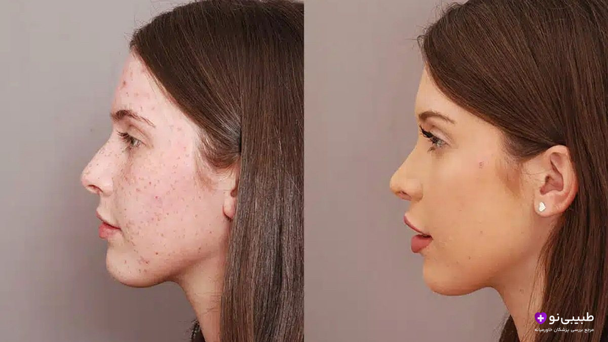 مقایسه نیم‌رخ قبل و بعد از سپتورینوپلاستی: چپ = انحراف شدید تیغه بینی و قوز بزرگ | راست = بینی صاف و متقارن پس از اصلاح هم‌زمان تیغه و شکل ظاهری