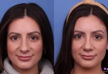 قبل و بعد تیپ پلاستی بینی از نمای روبه‌رو - اصلاح نوک بینی افتاده و سربالاکردن طبیعی