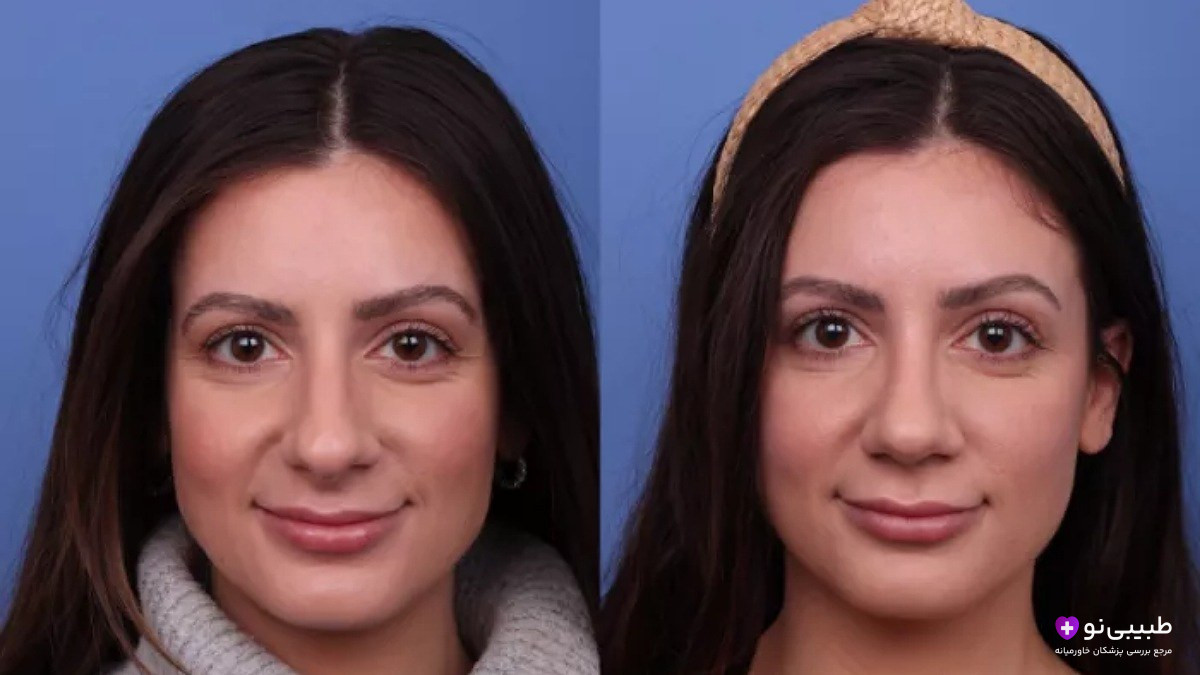 قبل و بعد تیپ پلاستی بینی از نمای روبهرو - اصلاح نوک بینی افتاده و سربالاکردن طبیعی