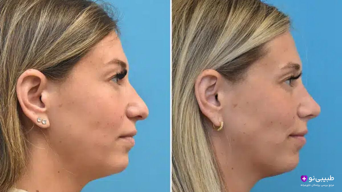 قبل و بعد تیپ پلاستی بینی زن جوان - اصلاح افتادگی نوک بینی و ایجاد فرم سربالا و طبیعی