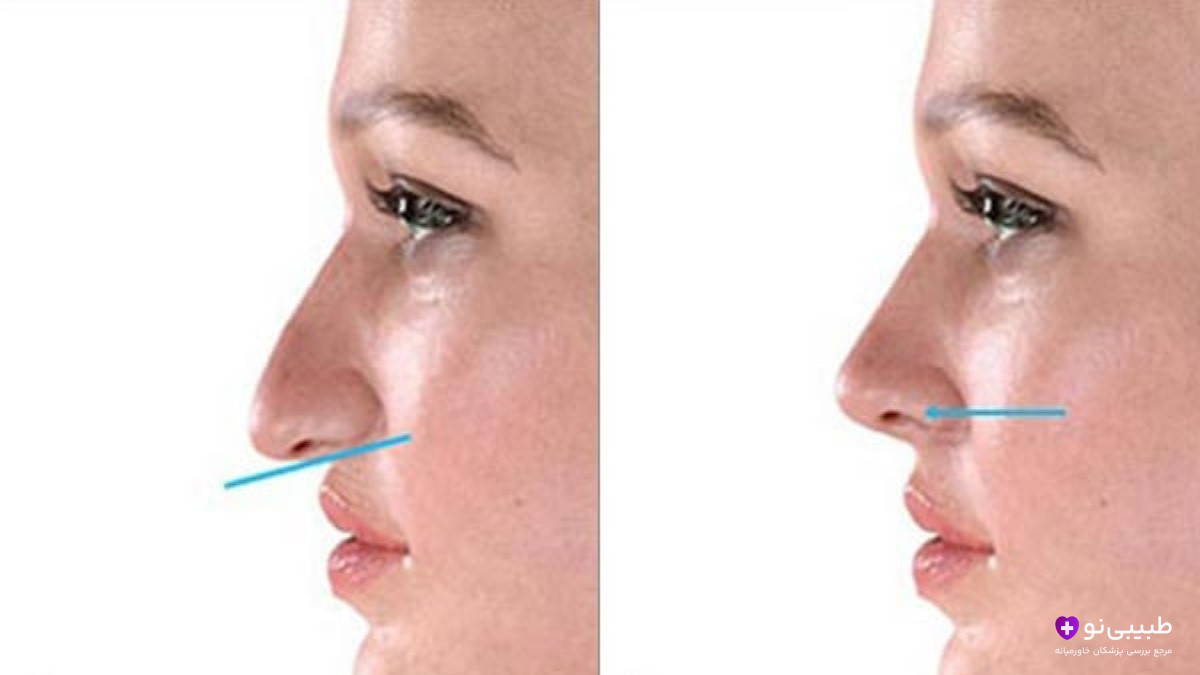 نتیجه قبل و بعد تیپ پلاستی بینی طبیعی - بالابردن نوک بینی بدون جراحی کامل