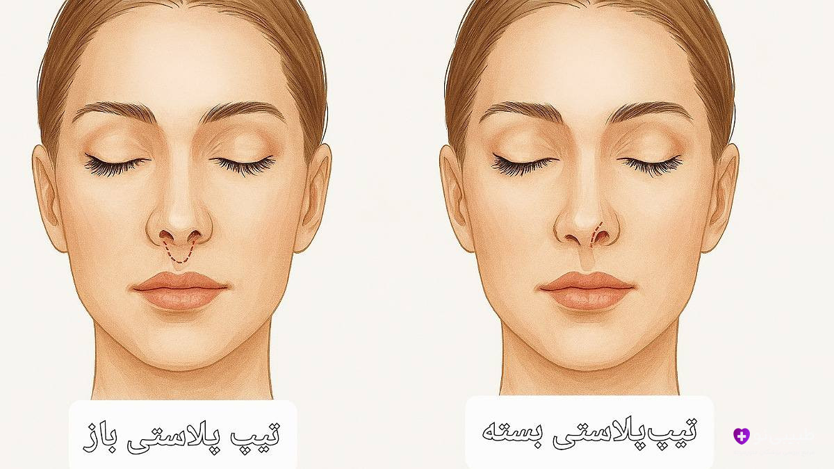 جراحی تیپ پلاستی باز و بسته - مقایسه تکنیک جراحی نوک بینی با برش خارجی و بدون برش