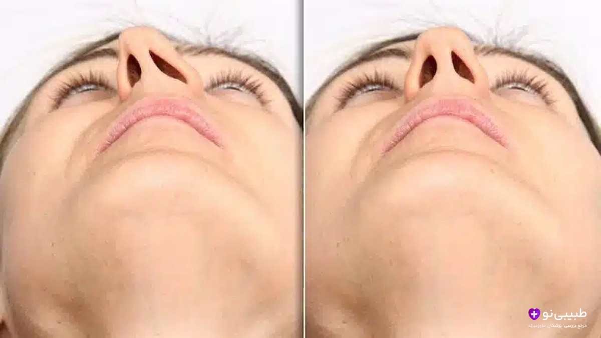 مقایسه نمای زیرین بینی قبل و بعد از سپتورینوپلاستی: اصلاح انحراف و جمع‌کردن پره‌ها پس از عمل