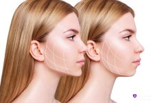 مقایسه نمای نیم‌رخ قبل و چند سال بعد از بوکال فت؛ خطوط سفید روی گونه و خط فک نشان‌دهنده کاهش دائمی حجم چربی بوکال و حفظ خط فک مشخص حتی پس از گذشت زمان و تغییرات وزنی است.