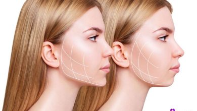 مقایسه نمای نیم‌رخ قبل و چند سال بعد از بوکال فت؛ خطوط سفید روی گونه و خط فک نشان‌دهنده کاهش دائمی حجم چربی بوکال و حفظ خط فک مشخص حتی پس از گذشت زمان و تغییرات وزنی است.