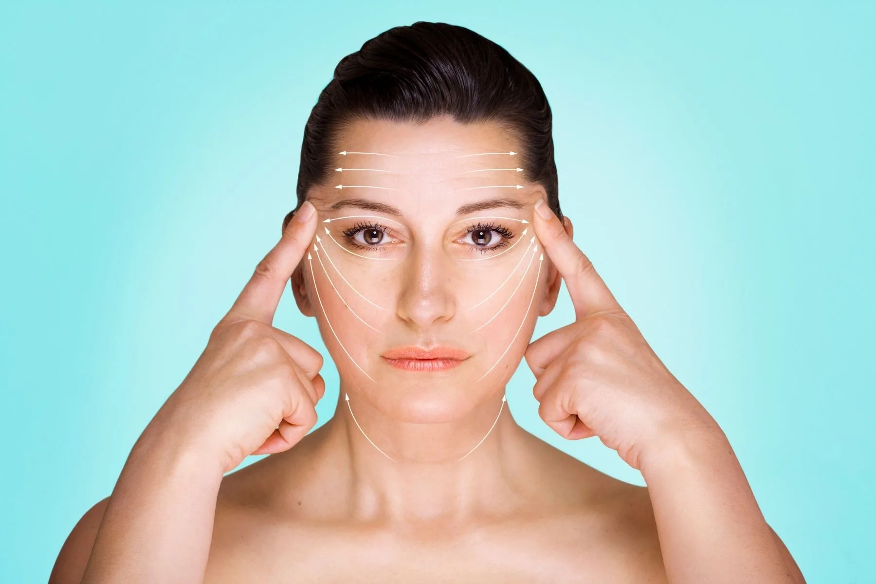 نمای روبرو از خانم میانسال با عارضه گودی شدید گونه پس از بوکال فت؛ خطوط سفید و فلشها نشاندهنده جهت تزریق دقیق چربی یا فیلر برای پر کردن گودی زیر گونه، بازسازی حجم میانی صورت و بازگرداندن تقارن و شادابی طبیعی به چهره هستند.