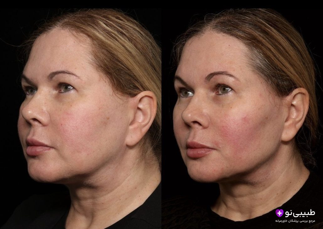 مقایسه قبل و چند سال بعد از بوکال فت در بیمار خانم میانسال؛ سمت چپ (قبل از عمل)؛ سمت راست (چند سال بعد) خط فک همچنان مشخص، گونه باریک و بدون بازگشت چربی بوکال،