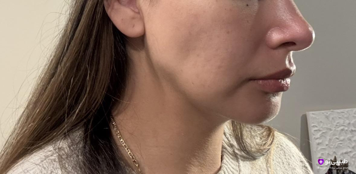 نمای نیمرخ خانم جوان چند سال پس از جراحی بوکال فت؛ بهدلیل برداشت بیشازحد چربی بوکال، گودی غیرطبیعی زیر گونه و ظاهر لاغر و پیرتر در ناحیه میانی صورت ایجاد شده است.