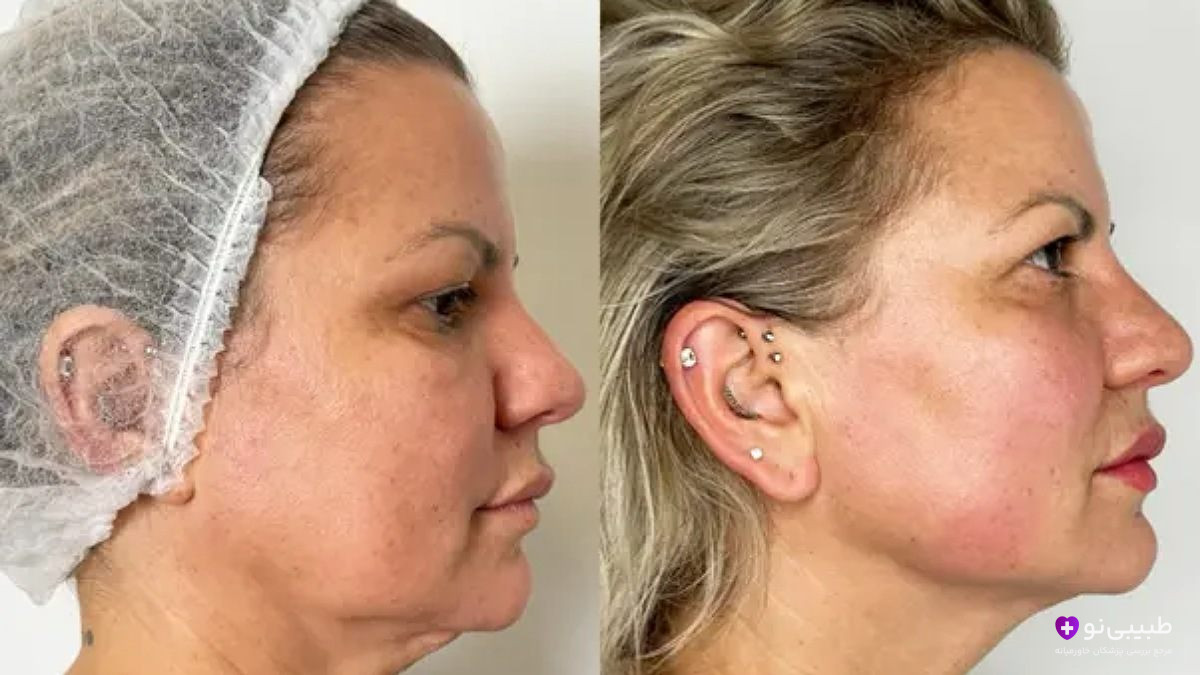 قبل و بعد اندولیفت صورت و غبغب | لیفت خط فک و حذف کامل غبغب بدون جراحی در یک جلسه