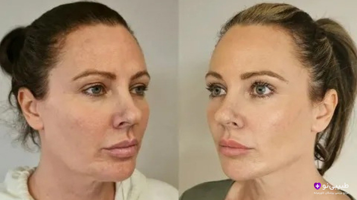 قبل و بعد اندولیفت صورت | لیفت غبغب، خط فک و جوانسازی طبیعی پوست بدون جراحی