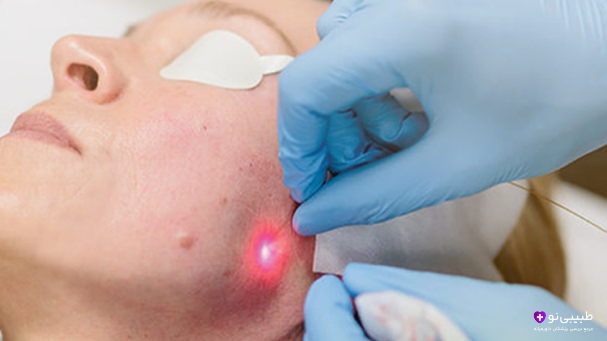  انجام اندولیفت صورت با فیبر نوری لیزر برای لیفت و جوانسازی پوست صورت و فک
کپشن: لحظه ورود فیبر نوری لیزر اندولیفت به زیر پوست صورت – لیفت فوری غبغب و خط فک بدون جراحی و با یک جلسه
