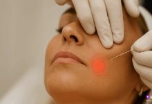 اندولیفت صورت با فیبر نوری در حال انجام توسط پزشک متخصص در کلینیک زیبایی کپشن: انجام اندولیفت صورت با استفاده از لیزر فیبر نوری برای لیفتینگ و جوانسازی پوست بدون جراحی – نتیجه طبیعی و ماندگار