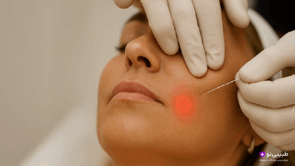 اندولیفت صورت با فیبر نوری در حال انجام توسط پزشک متخصص در کلینیک زیبایی کپشن: انجام اندولیفت صورت با استفاده از لیزر فیبر نوری برای لیفتینگ و جوانسازی پوست بدون جراحی – نتیجه طبیعی و ماندگار