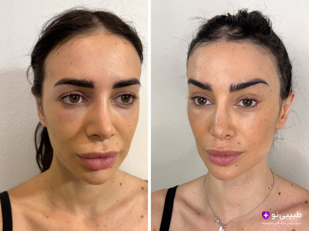 سمت چپ چهره با افتادگی ملایم گونه، پف زیر چشم و خطوط پیشانی؛ سمت راست (پس از عمل) گونه‌های لیفت‌شده، پیشانی صاف و ظاهری شاداب بدون اسکار قابل مشاهده. 