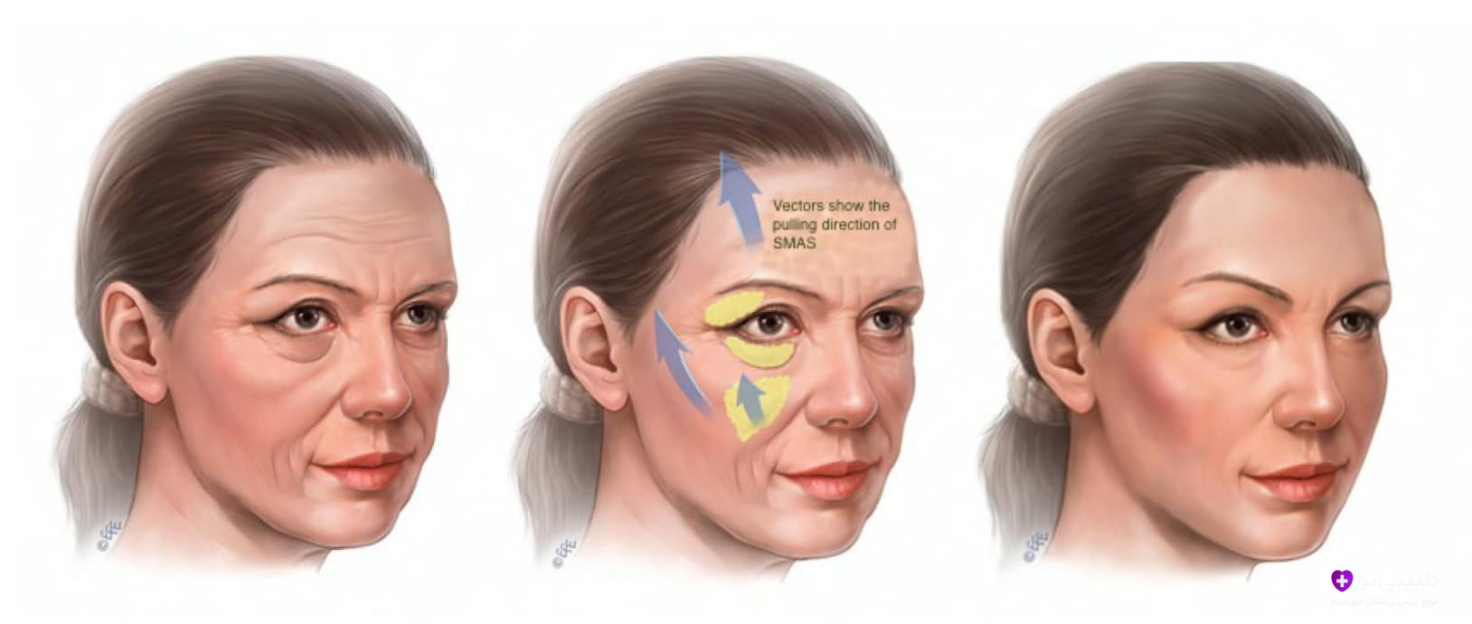  تصویر سه‌مرحله‌ای لیفت آندوسکوپیک صورت: مرحله اول وضعیت قبل از عمل؛ مرحله دوم نمایش جهت دقیق کشش لایه عمیق SMAS؛ مرحله سوم نتیجه نهایی.