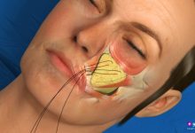 تصویر آناتومیک سه‌بعدی از مکانیسم لیفت آندوسکوپیک صورت؛ نخ‌های مخصوص از طریق برش‌های کوچک داخل خط رویش مو وارد شده و عضله و بافت چربی گونه (SMAS) را به سمت بالا معلق می‌کنند.