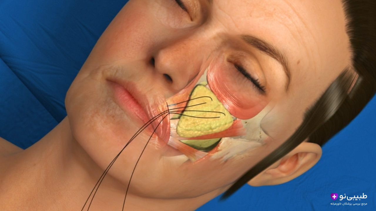 تصویر آناتومیک سه‌بعدی از مکانیسم لیفت آندوسکوپیک صورت؛ نخ‌های مخصوص از طریق برش‌های کوچک داخل خط رویش مو وارد شده و عضله و بافت چربی گونه (SMAS) را به سمت بالا معلق می‌کنند.