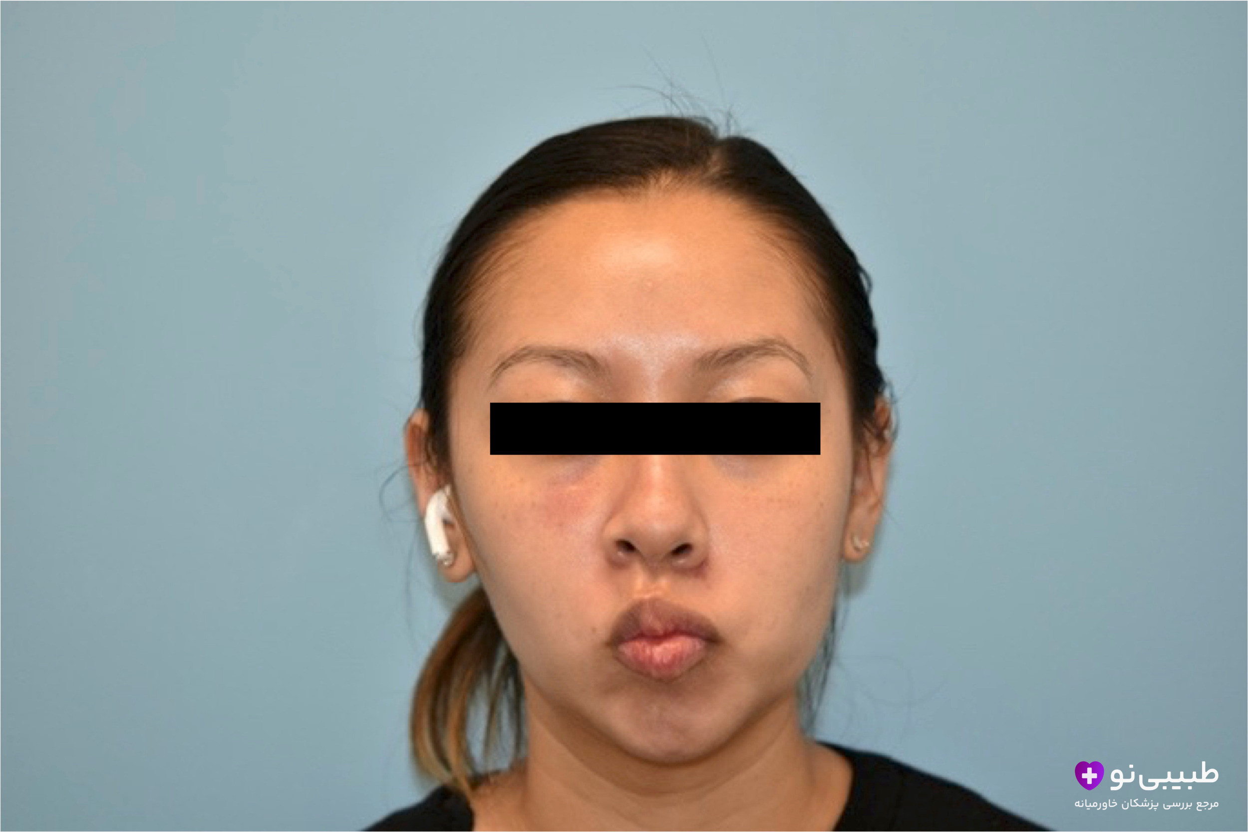 نمای روبرو از بیمار آسیاییتبار پس از بوکال فت نامتقارن؛ برداشت چربی بوکال در یک سمت بیشتر از سمت دیگر انجام شده که منجر به عدم تقارن شدید گونهها، گودی عمیقتر در یک طرف صورت و کجی ظاهری خط فک و لب شده است