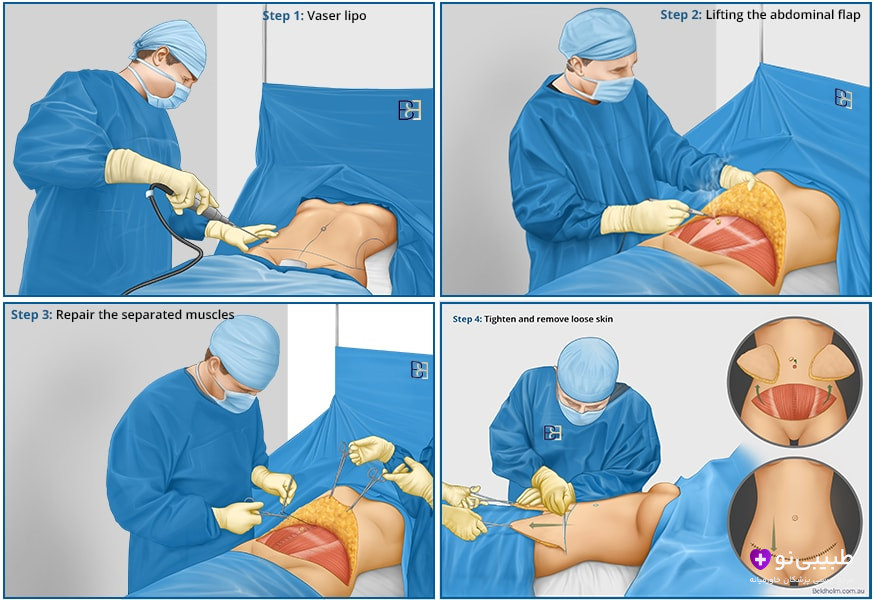 تصویر آموزشی چهارمرحله&zwnj;ای ابدومینوپلاستی: مرحله ۱ لیپوساکشن وازر، مرحله ۲ لیفت فلپ پوستی شکم، مرحله ۳ ترمیم عضلات جداشده دیواره، مرحله ۴ کشیدن و برداشت پوست اضافی با اسکار پایین شکم.