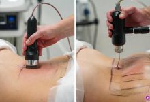 مقایسه ابزارهای لیپوماتیک و لیپوساکشن در حین عمل: سمت چپ دستگاه لیپوماتیک با هندپیس ویبره‌دار و کانولای نازک برای امولسیفیکاسیون چربی با حرکت نوسانی؛ سمت راست کانولای سنتی لیپوساکشن برای مکش مستقیم چربی.