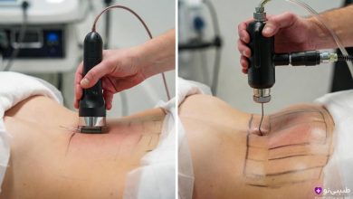 مقایسه ابزارهای لیپوماتیک و لیپوساکشن در حین عمل: سمت چپ دستگاه لیپوماتیک با هندپیس ویبرهدار و کانولای نازک برای امولسیفیکاسیون چربی با حرکت نوسانی؛ سمت راست کانولای سنتی لیپوساکشن برای مکش مستقیم چربی.