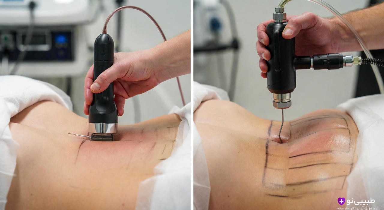 مقایسه ابزارهای لیپوماتیک و لیپوساکشن در حین عمل: سمت چپ دستگاه لیپوماتیک با هندپیس ویبره‌دار و کانولای نازک برای امولسیفیکاسیون چربی با حرکت نوسانی؛ سمت راست کانولای سنتی لیپوساکشن برای مکش مستقیم چربی.